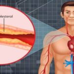इस चीज के सेवन से बढ़ता कोलेस्ट्रॉल, मौत का बन सकता है कारण,ऐसे करें बचाव